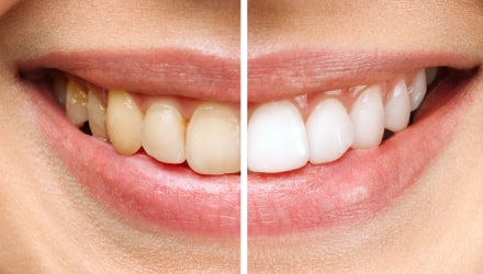 Estetica dental